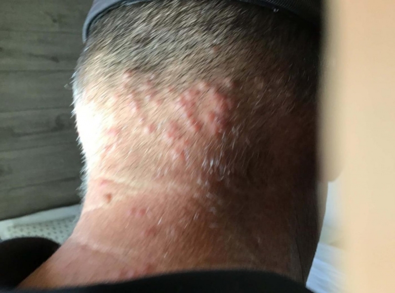 Отдых семьи обернулся кошмаром: кровати на курорте кишели клопами, а реакция туроператора шокировала туристов