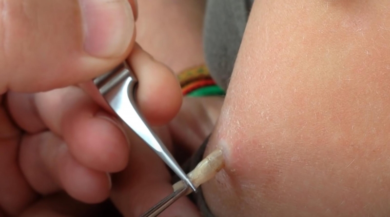 Российским туристам сообщили, как не привезти под кожей личинок из тропических стран